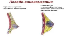 Як позбавитися в домашніх умовах Гінекомастія у чоловіків домашніх