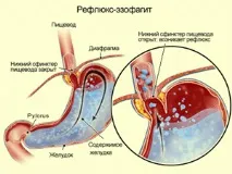Гастроезофагеальна рефлюксна хвороба (ГЕРХ) ГЕРХ