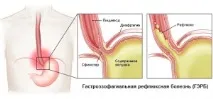 Гастроезофагеальна рефлюксна хвороба (ГЕРХ) стравоходу