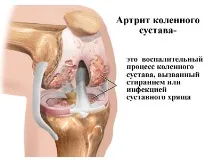 Інфекційний артрит причини виникнення, симптоми та методи лікування методи