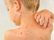 Як полегшити і позбутися сверблячки при вітрянці позбутися
