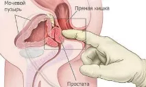 Як самому зробити масаж простати в домашніх умовах зробити