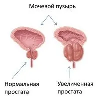 Як вилікувати передміхурову залозу залежно від виду хвороби залозу