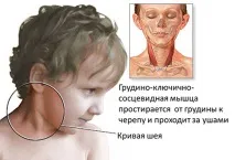 Кривошия у немовлят симптоми, ознаки, причини патологічного стану кривошия