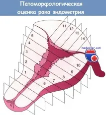 ендометрія