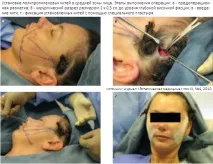 Нитки для омолодження особи тканин