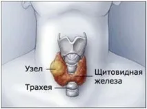 Народні засоби лікування щитовидної залози від вузлів щитовидної