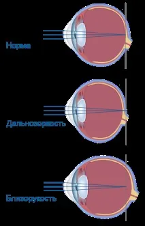 Порушення зору види порушень гостроти зору (близорукість і далекозорість), Що робити, якщо порушення