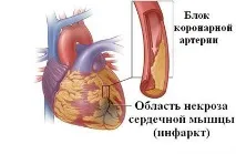 Передозування панангіном симптоми, наслідки, смертельна доза передозування