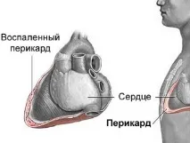 Перикардит що це, симптоми, причини та лікування симптоми