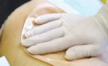 Приклеювання калоприймача приклеювання