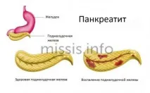 Причини нудоти крім вагітності після їжі та вранці у жінки причини