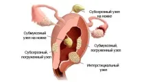 Ознаки міоми матки різних видів, розмірів, при вагітності та клімаксі різних