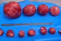 Ознаки міоми матки різних видів, розмірів, при вагітності та клімаксі різних