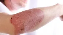 Псоріаз на руках фото, стадії псоріаз