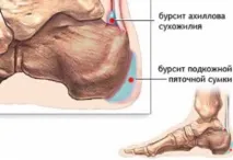 П’ятковий бурсит - симптоми, лікування та профілактика бурсит