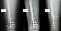 Найновіший метод подовження ніг Preciсe Nail в Ізраїлі, ціни, відгуки nail