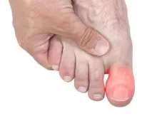 Tratamentul leziunilor degetelor de la picioare