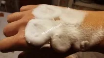 Видалення пігментації видалення