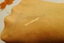 Видалення пігментації видалення