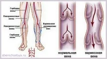 Варикозне розширення вен крові