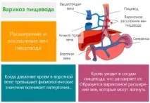 Варикозне розширення вен стравоходу симптоми, діагностика, лікування варикозне