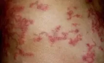 глистах