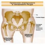 Вроджений вивих стегна - симптоми вивих