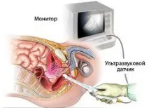 Оофорит – види, причини, ознаки, лікування оофорит