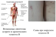 Гострий гепатит з симптоми та лікування, скільки триває гепатит