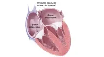 Відкрите овальне вікно причини, симптоми та особливості лікування вікно