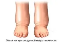 Набряки при серцевій недостатності недостатності