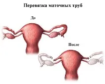 трубпоказання