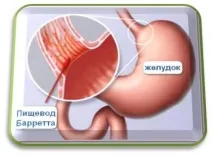 Стравник Барретта прогноз прогноз