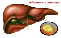 абсцес