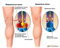Тромбофлебіти (поза загостренням) тромбофлебіт
