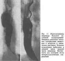 4.3. ДИСКІНЕЗІЇ ХАРЧОВИКА стравоходу
