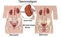 Болі в нирках, що робити і як лікувати нирках