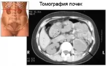Болі в нирках, що робити і як лікувати болі