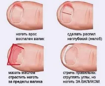 Болять пальці на ногах причини, як лікувати, що робити болять