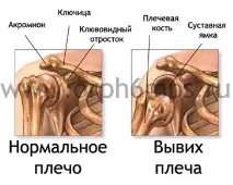 Реабілітація після вивиху плечового суглоба суглоба