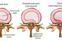 Екструзія міжхребцевих дисків, що це таке, лікування дисків