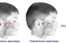 Інгаляції при аденоїдах у дітей інгаляції