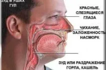 Краплі при полінозі полінозі