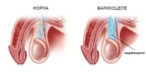 Операція при варикоцелі симптоми, методи лікування, рекомендації операція