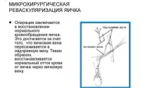 Операція варикоцеле у чоловіків види, скільки триває види