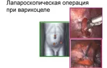 Операція варикоцеле у чоловіків види, скільки триває операція