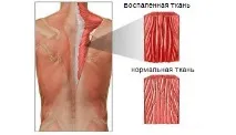 Від міозиту ніхто не застрахований. застрахований