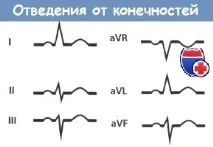 Відведення від кінцівок на ЕКГ у нормі I, II, III, aVR, aVL, aVF типі