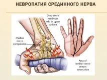 Периферична невропатія, ідіопатична та вегетативна, симптоми невропатія